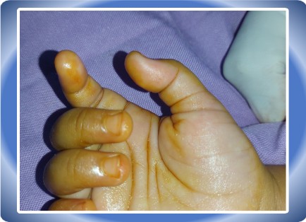 TRIGER FINGER